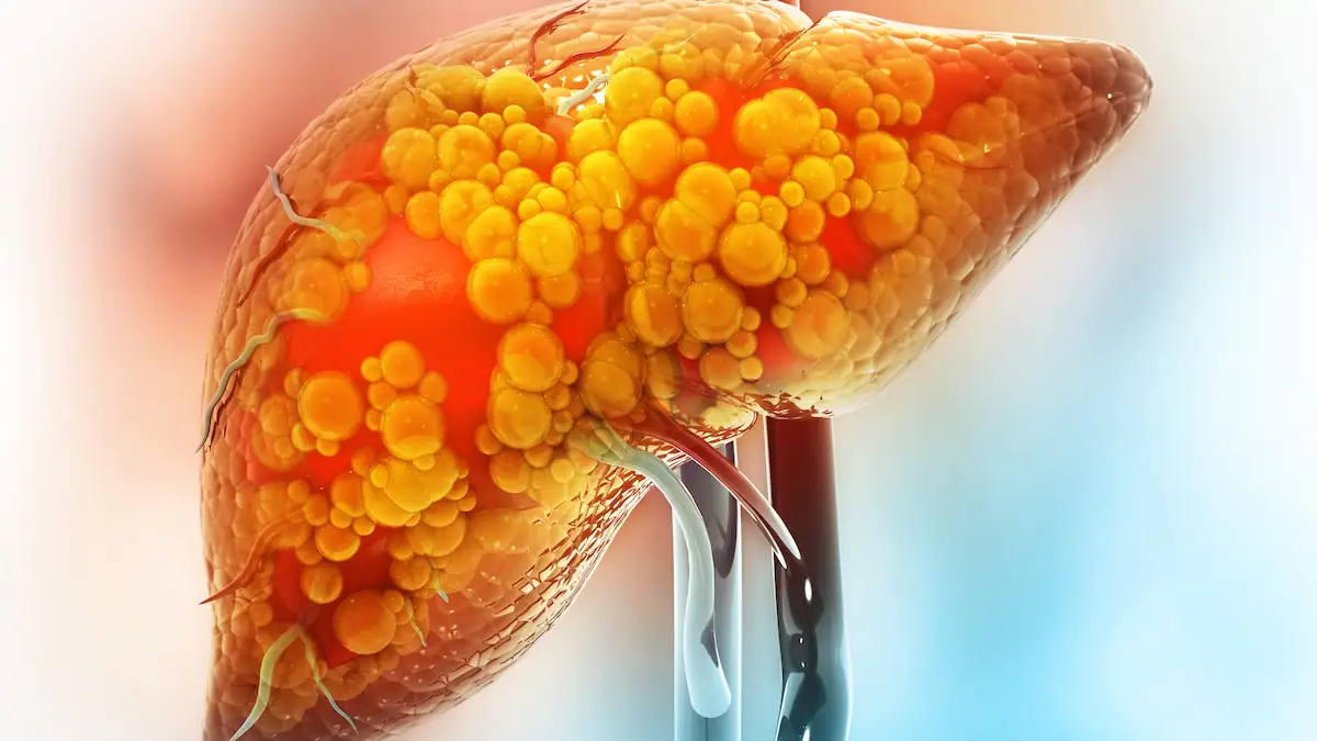 Leberzirrhose Symbolbild Fettleber