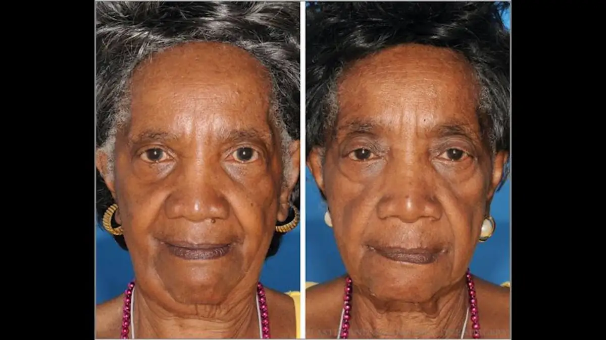 Bilder von eineiigen Zwillingen nebeneinander; der linke Zwilling ist Nichtraucher, die andere Raucher