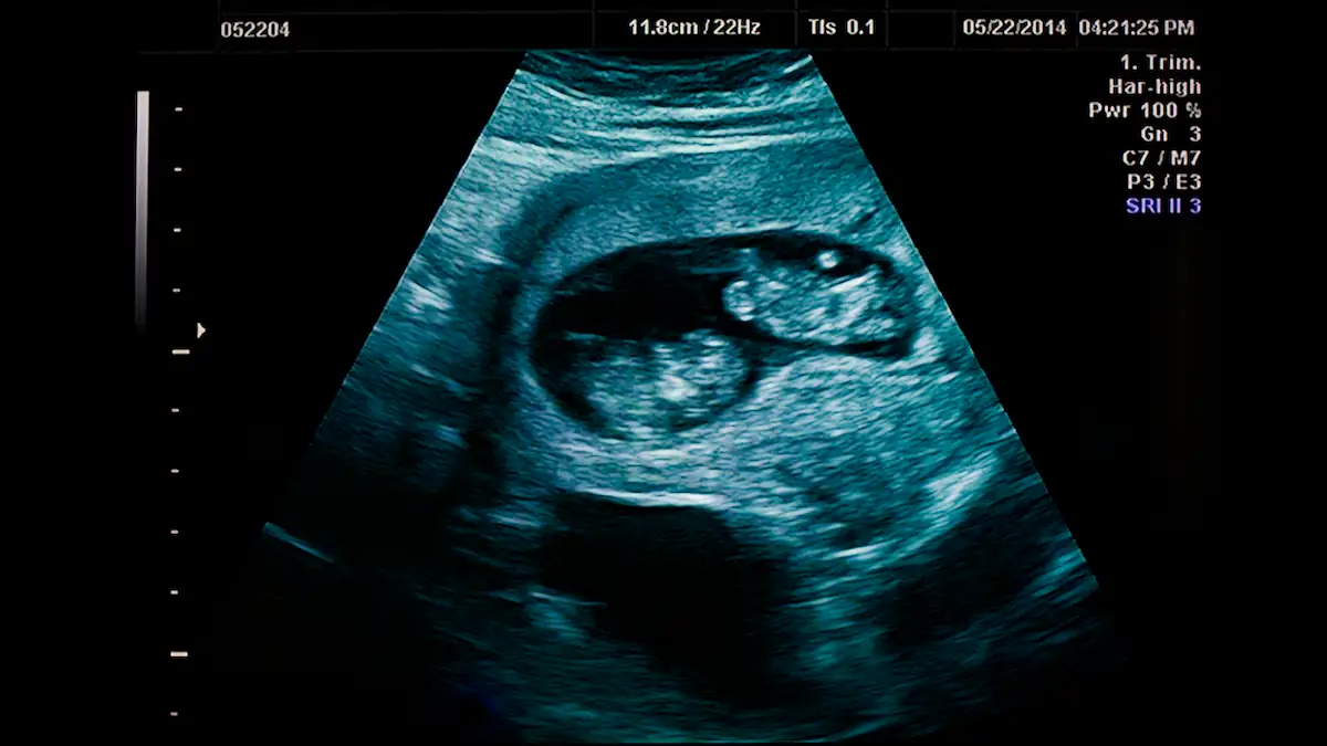 Zwillinge auf einem Ultraschallbild im Mutterleib