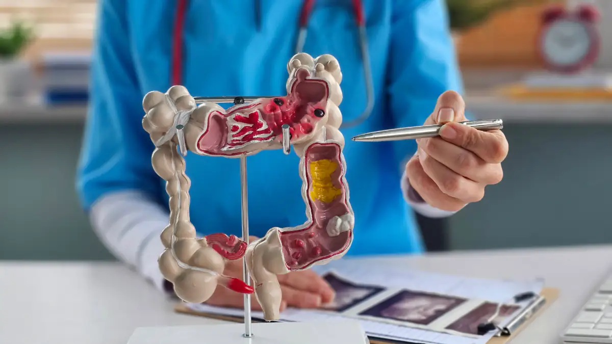 Ärztin zeigt auf Modell eines Darms und macht auf Darmkrebs aufmerksam