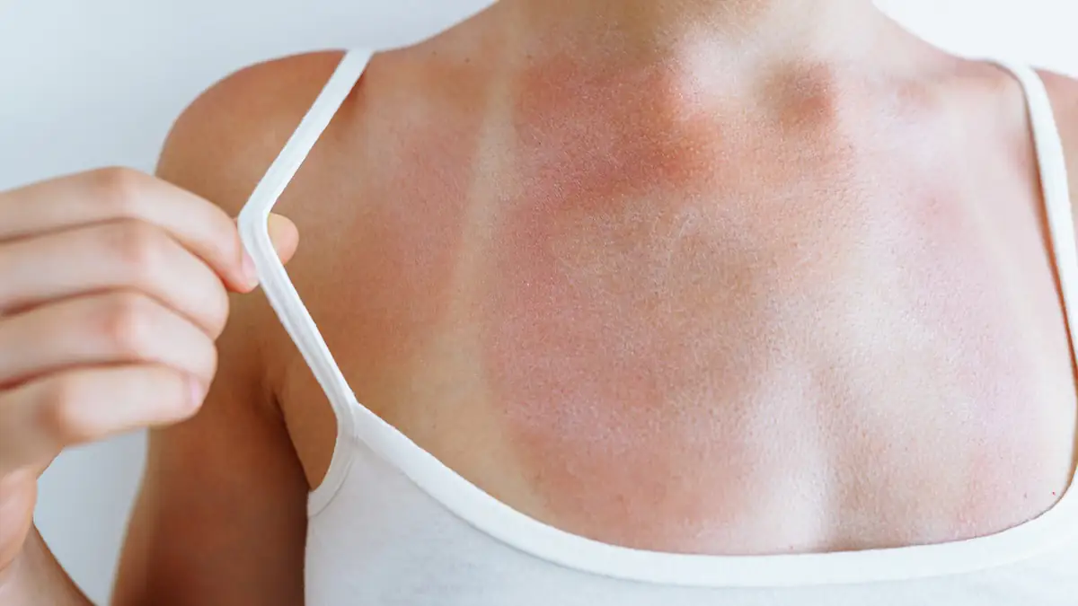 Hautkrebsrisiko durch Sonnenbaden: Sonnenbrand bei einer Frau