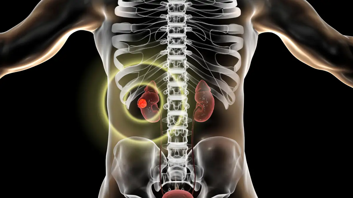 Cushing-Syndrom: Tumor in der Niere