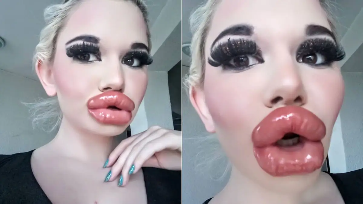 Bulgarien: Frau, die die größten Lippen der Welt haben möchte, lässt sie sich zum 20. Mal aufspritzen