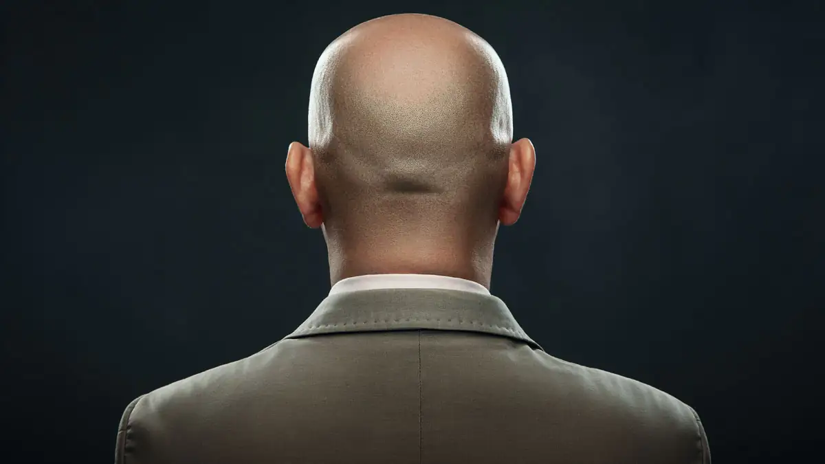 Studie: Männer, die zu viel arbeiten, bekommen eine Glatze