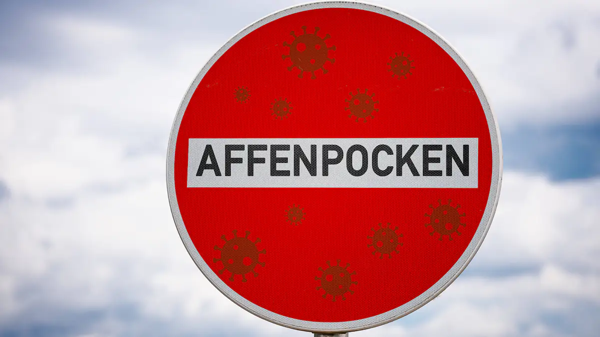 Affenpocken Virus verhält sich ungewöhnlich: WHO erwägt Gesundheitsnotstand