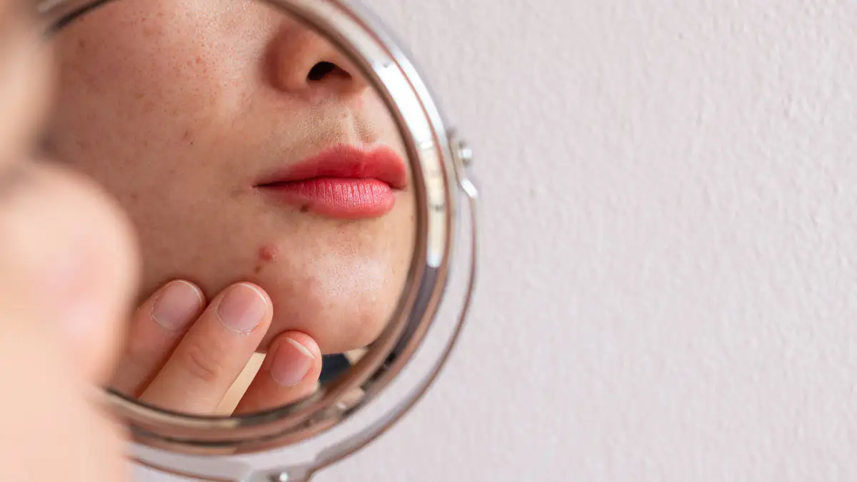 Was hilft gegen Pickel? Hausmittel im Überblick