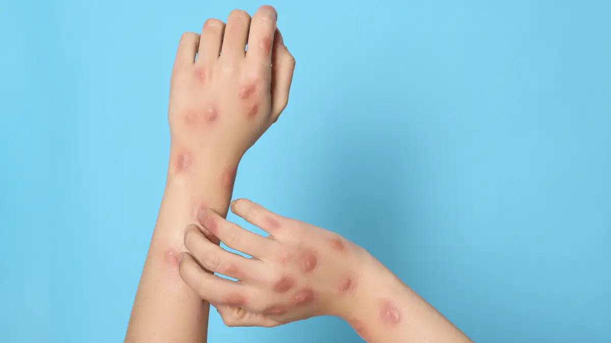 MPOX-Virus breitet sich aus - „Risiko für die ganze Welt“