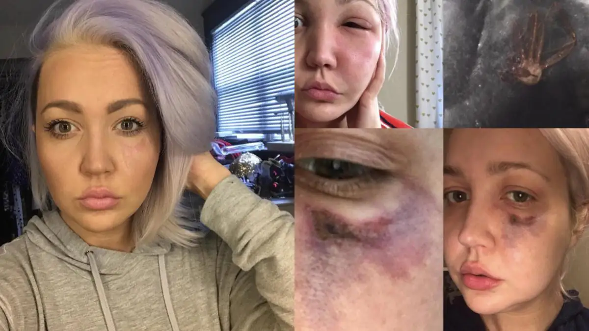 Ein Albtraum: Frau wacht mit Wunde im Gesicht auf – das ist der Grund