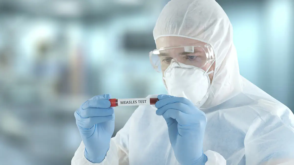 WHO warnt vor Infektion: Masern-Fälle steigen weltweit stark an