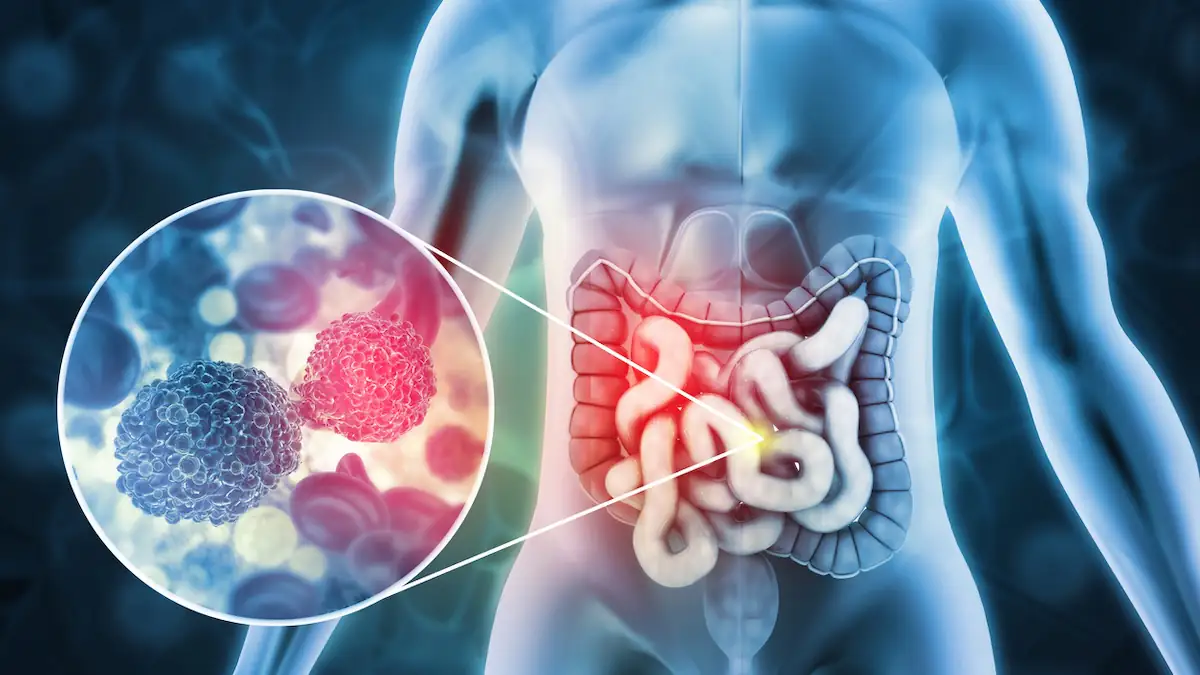 Beliebtes Getränk erhöht Risiko: Immer mehr junge Menschen leiden an Darmkrebs