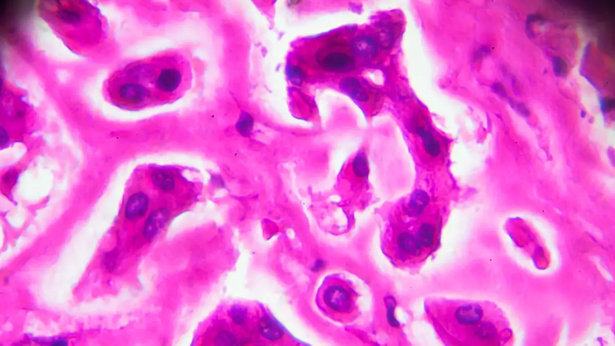 Erste Lepra-Fälle nach 30 Jahren: Mehrere EU-Länder melden Erkrankungen