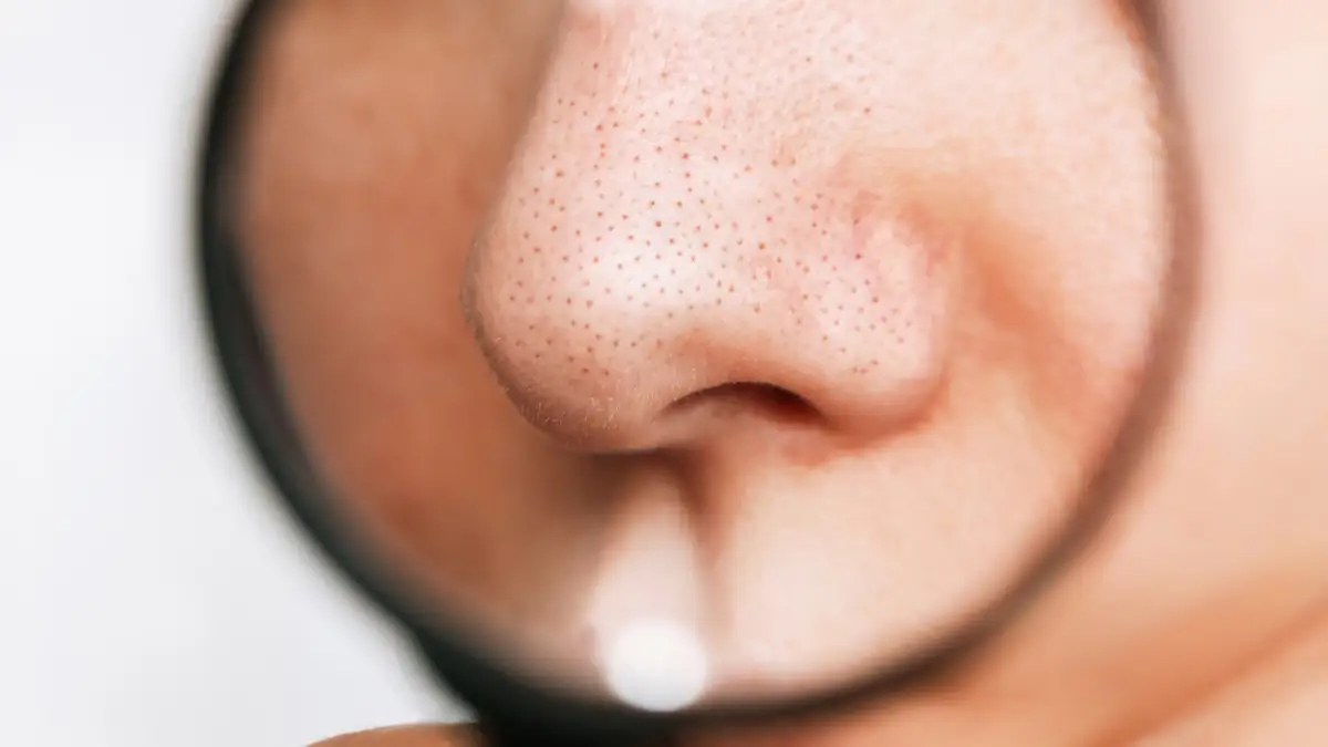 Sehen aus wie Mitesser: Dermatologin warnt davor, die schwarzen Punkte auf der Nase auszudrücken