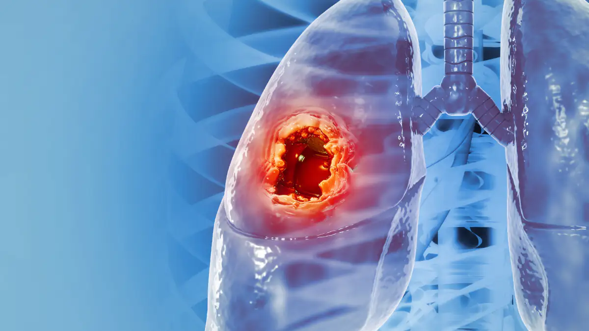 Krebs-Risiko: Zwei Angewohnheiten spielen laut Forschern eine wichtige Rolle