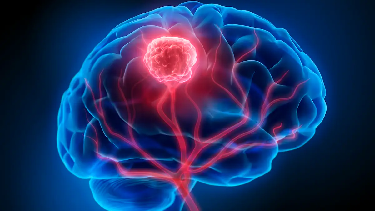 Arzt diagnostizierte Migräne, in Wirklichkeit war es ein Hirntumor