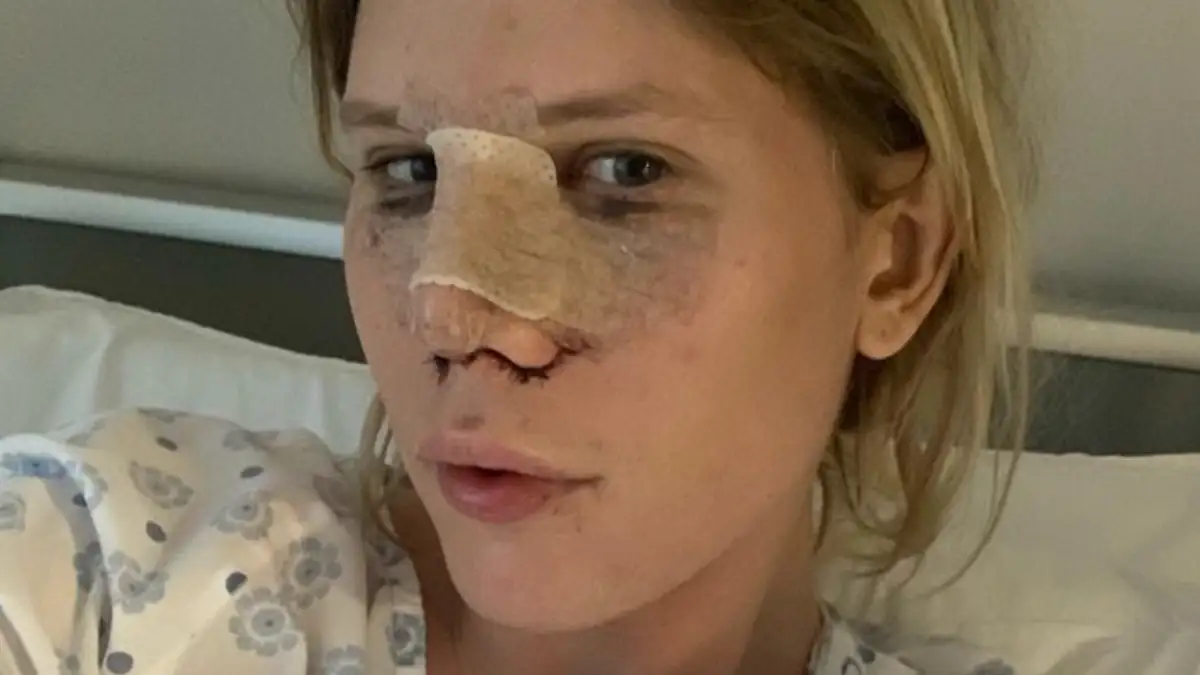 Gefährliche Beauty-OPs in der Türkei: Arielle Rippegather warnt ihre Fans