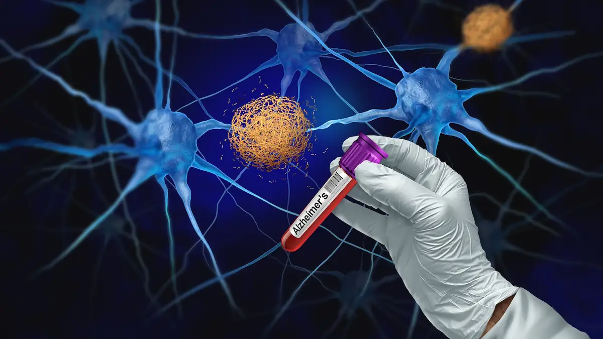 Impfung gegen Alzheimer? Neue Studie macht Hoffnung