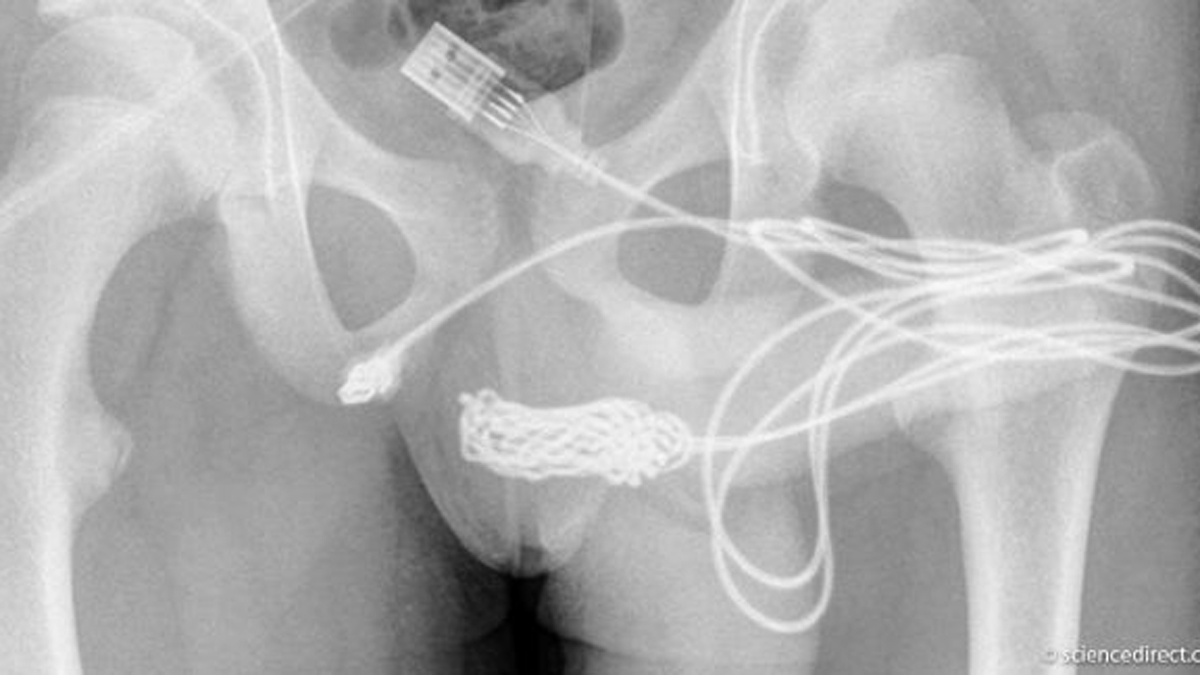 USB-Kabel in Penis geschoben: „Sexuelles Experiment“ endet im Krankenhaus