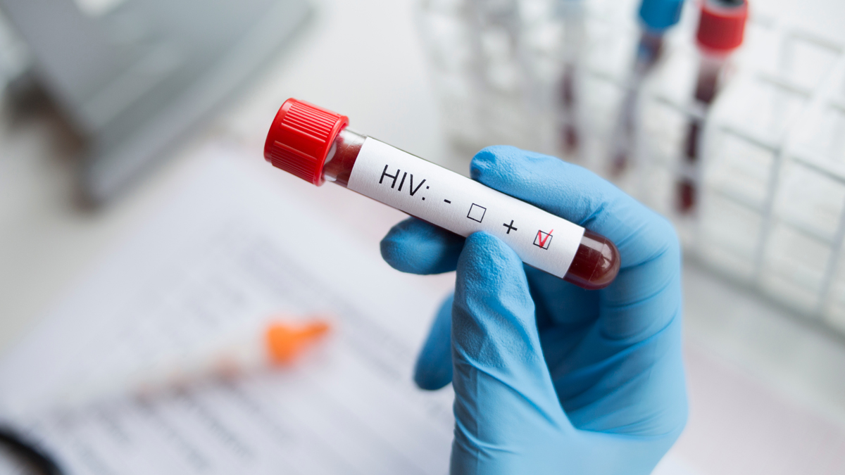 Gefährliche neue HIV-Variante in den Niederlanden entdeckt